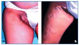 varicoza hormonal pelvic venele varicoase ale diagnostice inferioare