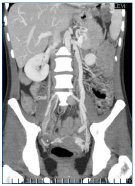 varicose pelvis ca examinând