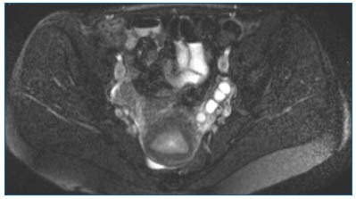 vinei varicoase de pelvis phlebodia