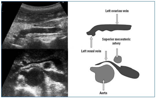 varicose pelvis ca examinând