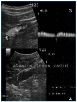 varicose pelvis ca examinând apele termale i varicoza