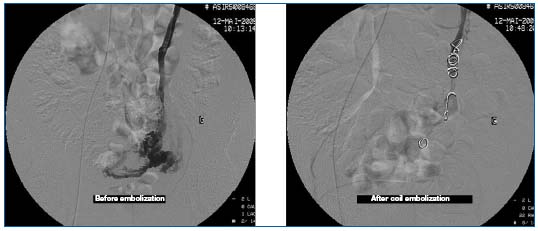 varicoza organe de pelvis mic dupa livrare