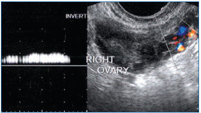 The relation between pelvic varicose veins, chronic pelvic pain, and