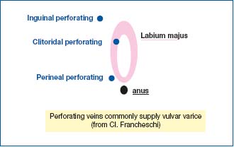 vulva clitoral veins varicose