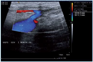 randomized control trials on sclerotherapy for varicose testicular ultrasound
