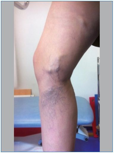 Figure 1. Large varicose vein parallel to the path of the greater saphenous vein and telangiectasia; appeared in the fourth month of pregnancy. Note the likely perforating vein. (C1 and C2 of the CEAP classification) (Photo ACT).