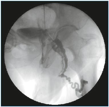 Figure 2. Selective pelvic venography. After a Valsalva maneuver. Reflux through the obturator vein feeding the nonsaphenous vein network. (Courtesy of Drs Monedero and Zubicoa).