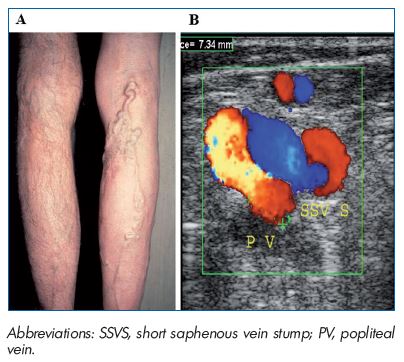 Figure 4. PREVAIT clinical aspect. A. Popliteal fossa massive recurrence related to non-flush high ligation in a patient with an incompetent SSV terminal valve. B. Postoperative duplex scanning identified reflux in the SSVS, which feeds the varicose network after the compressiondecompression maneuver. (Courtesy of Dr Gillet).