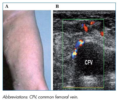 Figure 5. PREVAIT clinical aspect. A. A varicose network at the thigh just below a previous groin incision related to neovascularization. B. Same patient with a duplex scan. Small refluxive veins identified above the CFV after a Valsalva maneuver. (Courtesy of Dr Gillet).