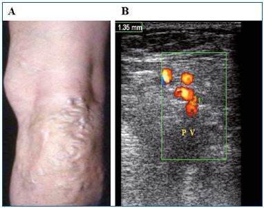 Figure 6. PREVAIT clinical aspect. A. A varicose network at the popliteal related to neovascularization. B. Same patient with a duplex scan. Varicose network above a refluxive popliteal vein (Courtesy of Dr Gillet).