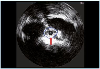 Figure 3. Intravascular ultrasound (IVUS) is able to detect iliac obstruction.