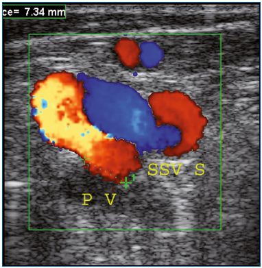 Figure 2. Presence of varices in the popliteal fossa in a patient previously treated by saphenopopliteal ligation. Postoperative duplex scanning identified reflux in the SSVS that feeds the varicose network after the compression-decompression maneuver. Abbreviations: PV, popliteal vein; SSVS, short saphenous vein stump. Image courtesy of Dr Gillet.