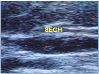 Figure 2. Thrombosis in the small saphenous vein 6 hours after a flight.