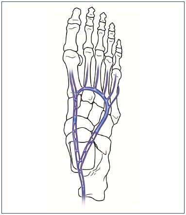 Figure 2. Deep plantar veins projected over the foot bones.