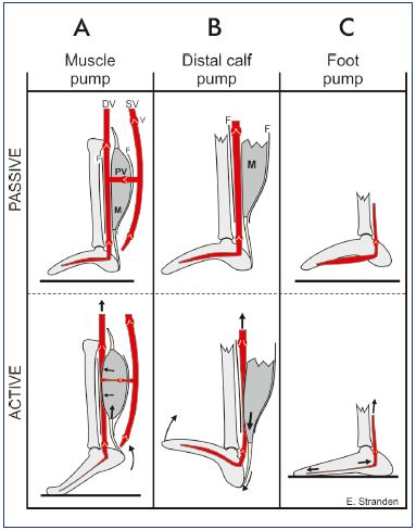 Figure 5. Mechanism of action for the distal calf pump. Panel A. Muscles (M) are unsheathed by common fascia (F) and veins within the same compartment. Contraction of the calf muscles, as in plantar flexion of the ankle joint during walking (bottom), expels blood into the proximal collecting vein. During relaxation (top), the blood is drained from the superficial veins (SV) into the deep veins (DV) in addition to the arterial inflow; thereby, preparing for the subsequent ejection. V, venous valve. Panel B. Distal calf pump: upon dorsiflexion of the ankle (passive or active), the bulk of the calf muscle (M) descends within the fascial sheath (F) and expels blood in the distal veins like a piston. Panel C. The venous foot pump: upon weight bearing, the tarso-metatarsal joints are extended and the tarsal arch is flattened. Thus, the veins are stretched, causing them to eject their content of blood. Image courtesy of E. Stranden.