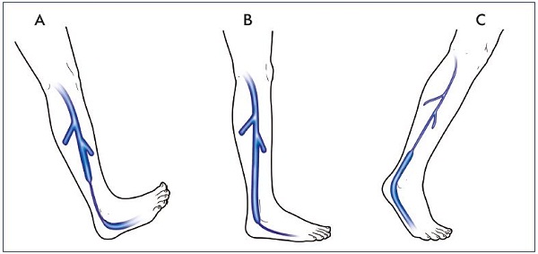Figure 9. Synchronization of the leg pumps. Dorsiflexion, weight bearing, and plantar flexion lead to distal calf pump emptying (Panel A), foot emptying (Panel B), and upper calf emptying (Panel C), respectively.