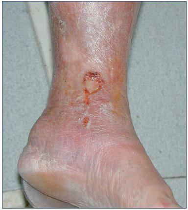 Figure 11. Supramalleolar ulcer associated with lipodermosclerosis and skin pigmentation.