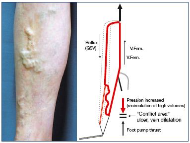 Figure 12. Varices of the calf fed by saphenous incompetence have the main reentry point at the distal calf. At the foot, varicose dilatation exists, which is separated from venous incompetence. Abbreviations: GSV, great saphenous vein; V.Fem., femoral vein.