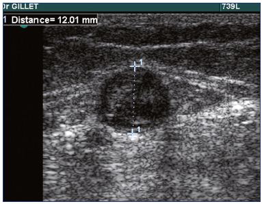 Figure 1. Ultrasound of thrombosis of the small saphenous vein.