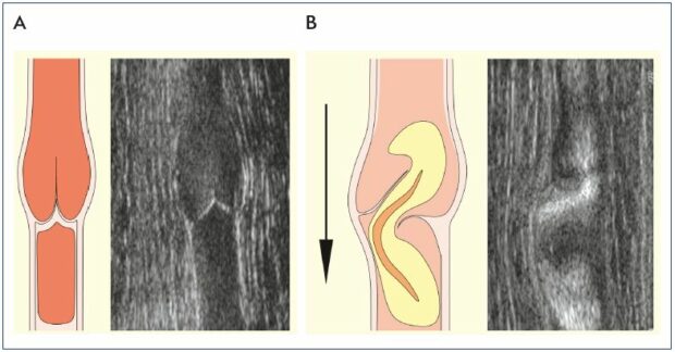 Figure 1. Visualization of competent and incompetent venous valves. Competent (Panel A) and incompetent (Panel B) venous valves showing schematic and B-flow ultrasound images. In Panel B, the valve sinus is distorted. The cusp above the dilatation is frozen and the adjacent cusp is prolapsed. The high-velocity retrograde streaming deviates laterally above a prolapsing cusp. From reference 6: Lane et al. Phlebolymphology. 2007;14:105-115. Image courtesy of the author.