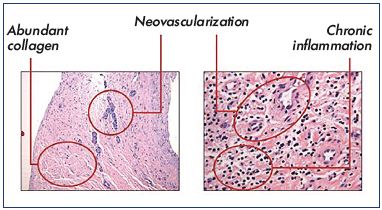Figure 2. Hematoxylin/eosin staining showing abundant collagen, neovascularization, recanalization, and inflammation in the common femoral vein.
