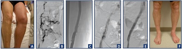 Figure 3. Posttreatment assessment of a patient with deep vein thrombosis treated by pharmacomechanical thrombolysis and stenting after unsuccessful anticoagulation. Photograph of a patient with severe acute phlegmasia cerulea dolens after 5 days of treatment with low-molecular-weight heparin (Panel A). Iliofemoral phlebogram showing extensive venous obstruction (Panel B). Patency restoration to the femoral vein (Panel C) and the iliac venous system (Panel D) after pharmacomechanical thrombolysis. The patient had persistent obstruction of the common iliac vein, which was corrected with a 16-mm bare-metal stent (Panel E). At the 36-month follow-up, the physical examination was normal and the veins were patent with normal valve function (Panel F).