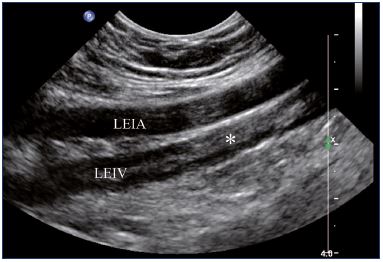 Figure 1. Residual fibrotic thrombus* in the left external iliac vein (sagittal view). Abbreviations: LEIA, left external iliac artery; LEIV, left external iliac vein.