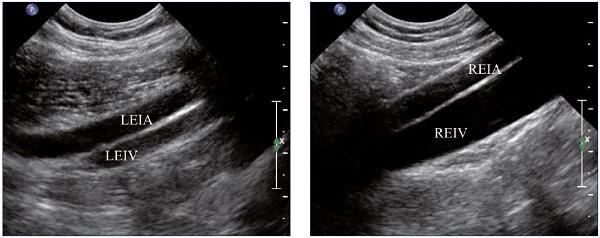 Figure 4. External iliac veins (longitudinal view). Panel A shows shrinking of the LEIV. Panel B shows a healthy REIV. Abbreviations: LEIA, left external iliac artery; LEIV, left external iliac vein; REIA, right external iliac artery; REIV, right external iliac vein.