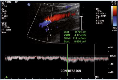 Figure 13. Increase in the femoral vein flow during great saphenous vein compression.