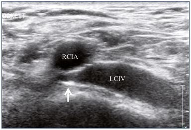 Figure 16. Inadequate angioplasty and stenting of the left common iliac vein with residual stenosis. Abbreviations: LCIV, left common iliac vein; RCIA, right common iliac artery.
