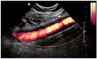 Figure 17. Power Doppler showing an intrastent intimal hyperplasia of the external iliac vein (longitudinal view).