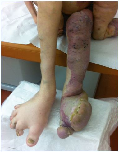 Figure 4. Foot deformity in a case of Klippel-Trenaunay syndrome.