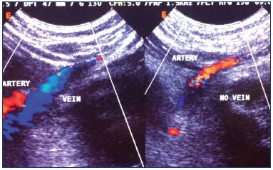 Figure 6. Duplex scan of the popliteal area showing aplasia of the left popliteal vein (right).