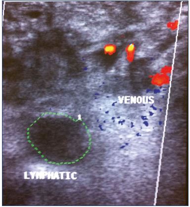 Figure 7. Duplex scan showing the presence of dysplastic intramuscular veins (low flow) and a large lymphatic area (no flow).