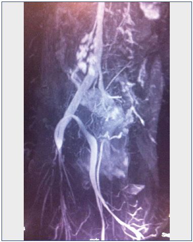 Figure 8. Magnetic resonance angiography demonstrating aplasia of the left iliac vein and spontaneous suprapubic leftright bypass.