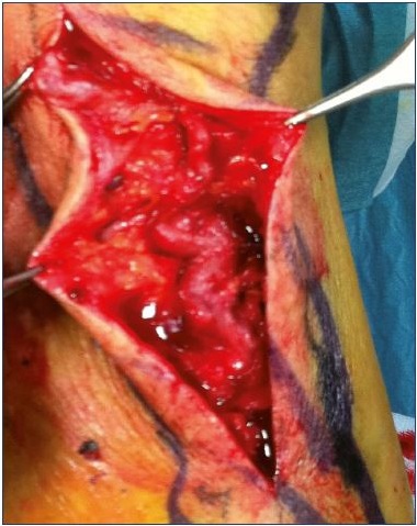 Figure 10. Abnormal superficial veins on the calf that need to be removed.