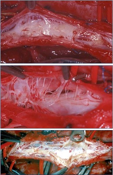 Figure 1. Endoluminal images after phlebotomy of the common femoral vein.