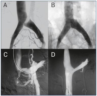 Pelvic Venous Congestion Syndrome