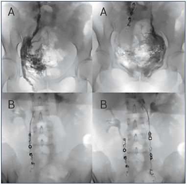 Treatment options for pelvic congestion syndrome - Servier -  PhlebolymphologyServier – Phlebolymphology