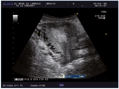 ultrasunete varicoza pelvic