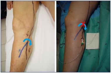 great saphenous vein removal
