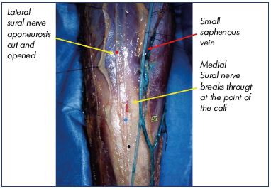 great saphenous vein removal