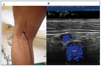 Small saphenous vein interventional treatment - Servier