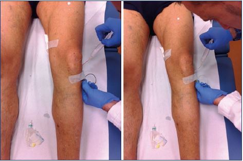 injection varicose reviews pret karaganda picior varicoză