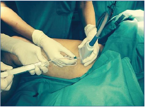 Ultrasound-guided sclerotherapy treatment helps avoid intra-arterial injection