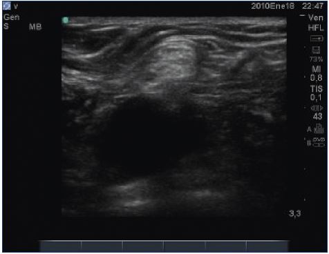 Nerves are readily visualized on most modern ultrasound systems and inadvertent damage can be mostly avoided