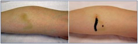 Drainage of postsclerotherapy intravascular thrombi helps to prevent hyperpigmentation
