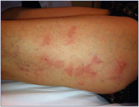 Transitory localized urticaria after injection