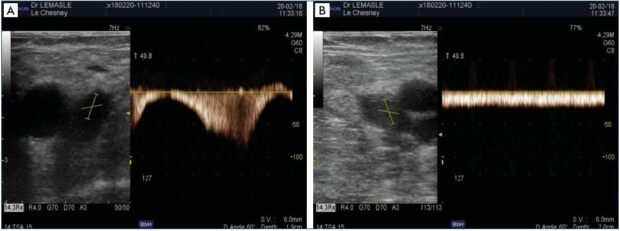 Profile of venous flow in the common femoral vein
