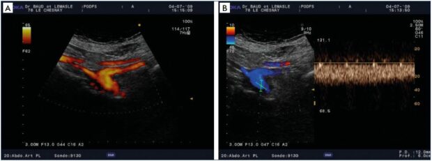 Chronic postthrombotic obliteration of the left common iliac vein Drainage of the external iliac vein by the enlarged internal iliac vein – distal common iliac vein with decreased caliber Permanent, demodulated, inverted flow in the substitute internal iliac vein